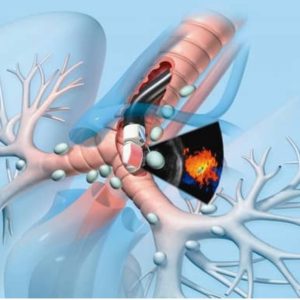 WORKSHOP ON INTERVENTIONAL PULMONOLOGY