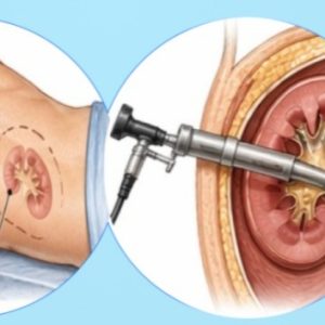 Personalised PCNL Training at IRCAD India